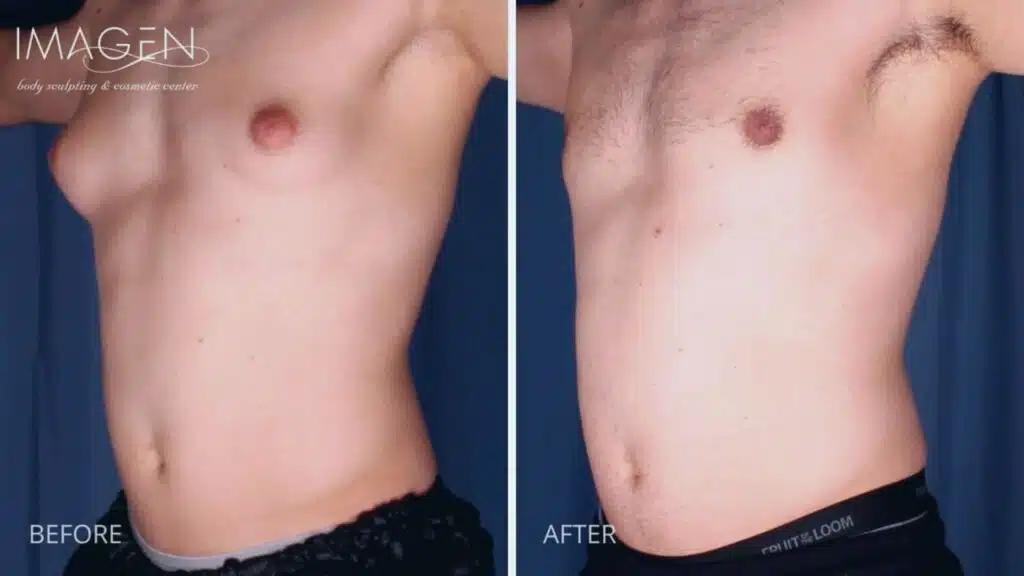 Before and after gynecomastia chest contour at Imagen
