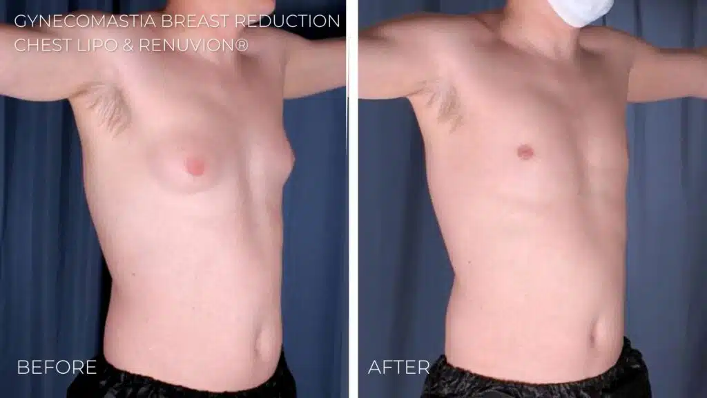 Before and after male chest reduction with Renuvion