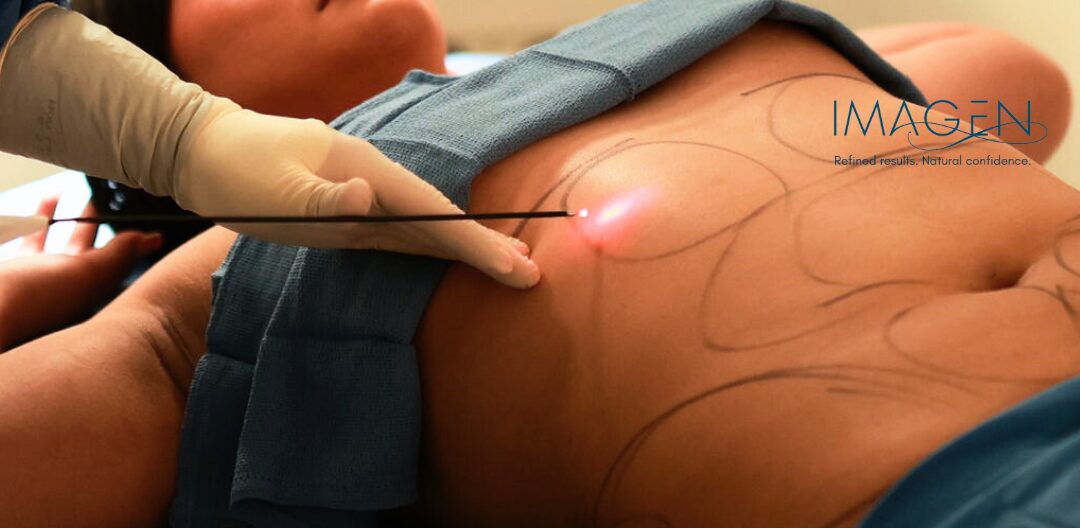 Cheap Liposuction in Omaha