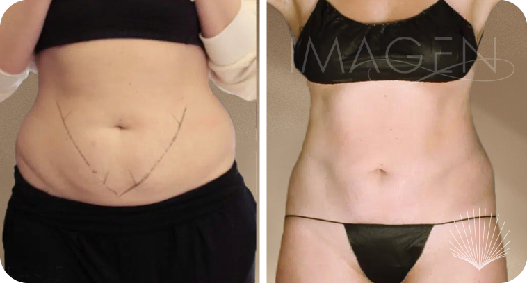 IMA-BEFORE-&-AFTER-Procedures-BODY_coolsculpting