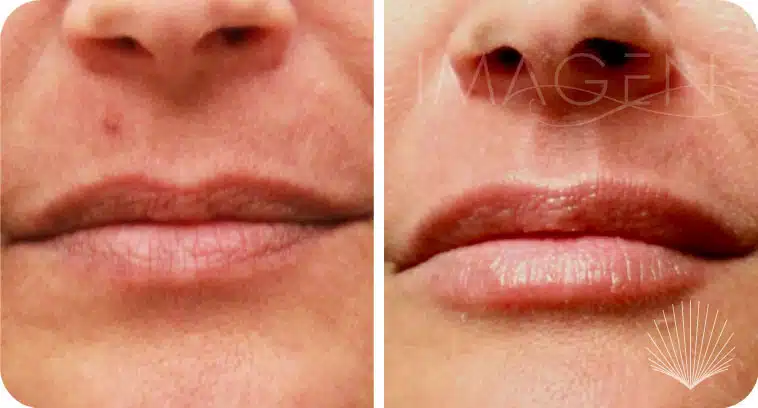Before and after