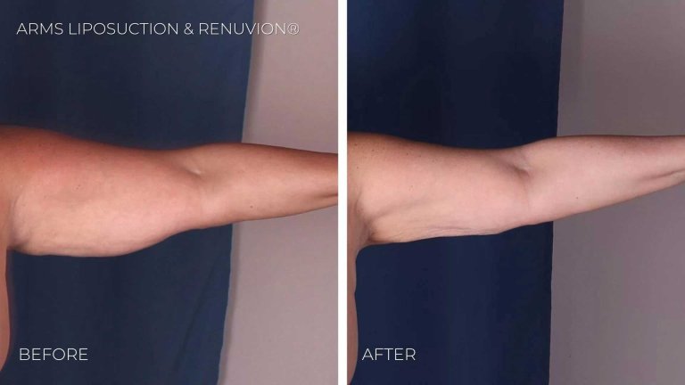 BA-arms-liposuction-renuvion