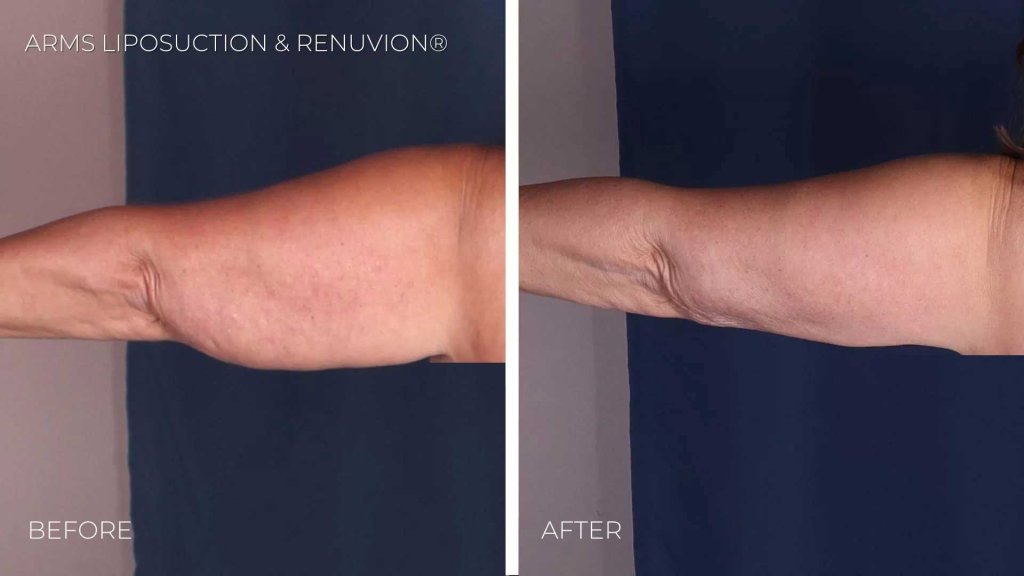 BA-arms-liposuction-renuvion2