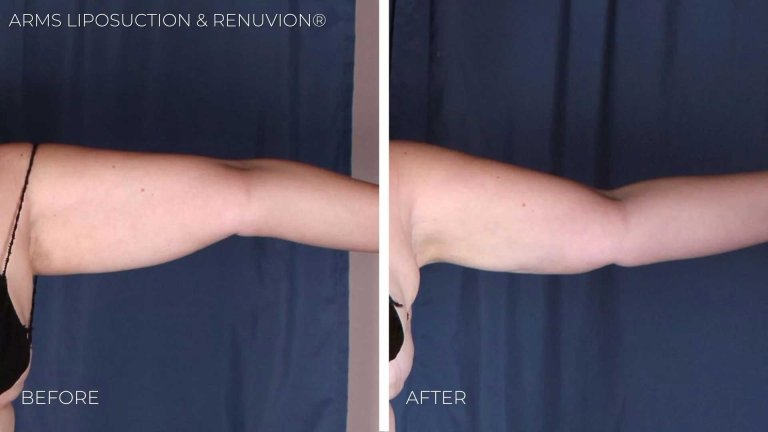BA-arms-liposuction-renuvion3