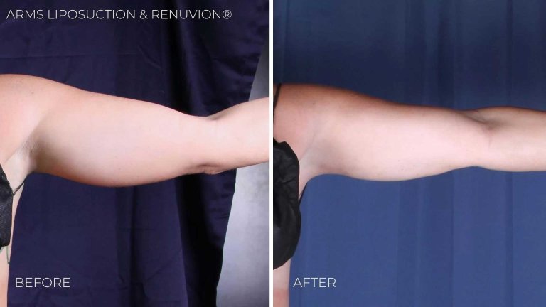 BA-arms-liposuction-renuvion4