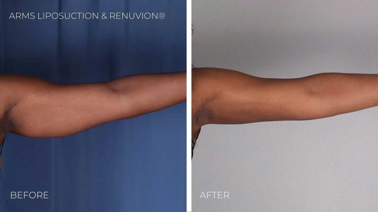 BA-arms-liposuction-renuvion5