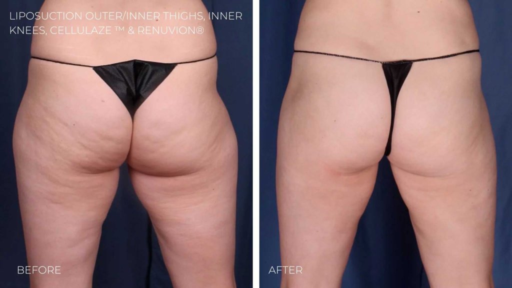BA-lipo-inner-outer-thighs-inner-knees-cellulaze-renuvion2