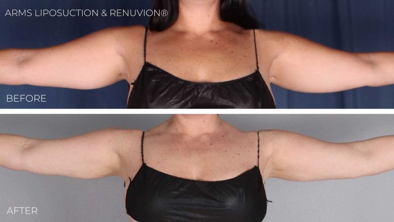 BA-liposuction-saggy-loose-arms-fat