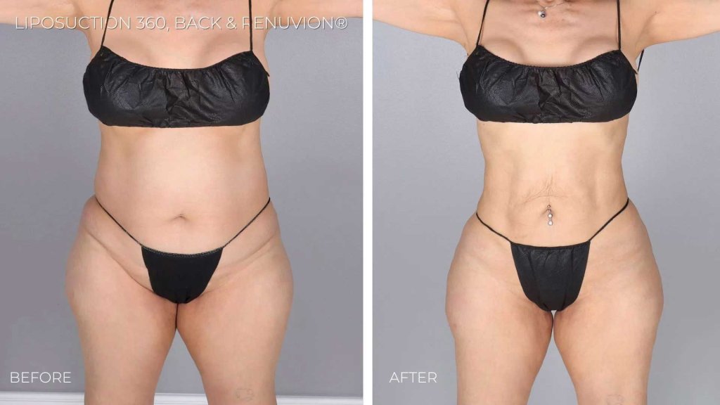 BA-liposuction360-back-renuvion