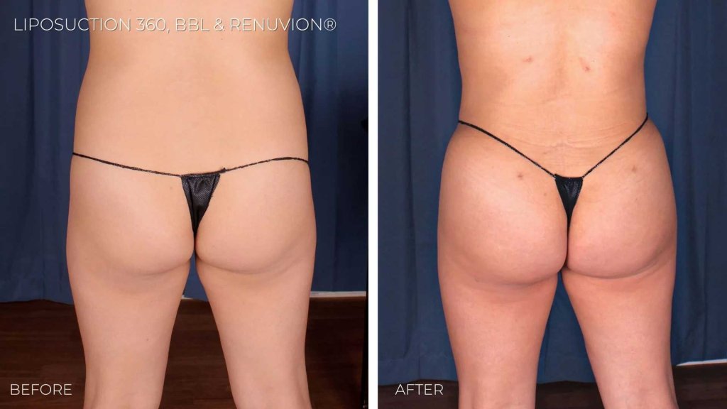 BA-liposuction360-bbl-renuvion4