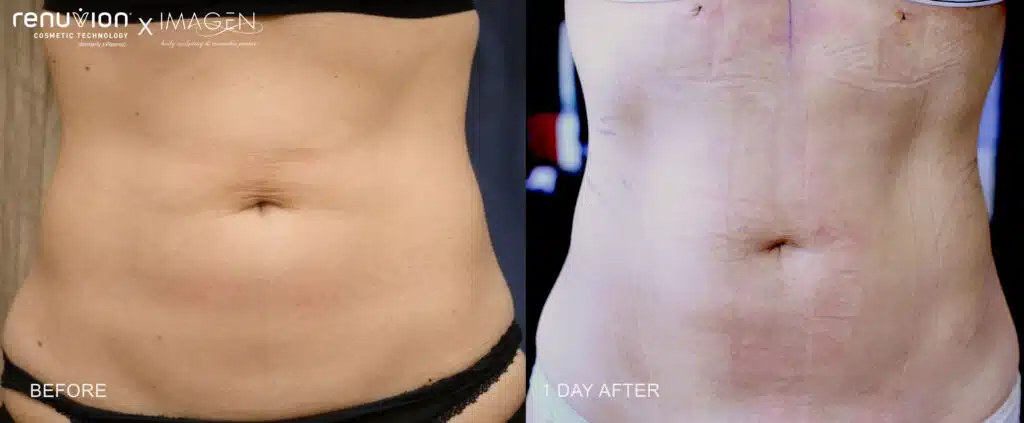 Before and after abdominal Renuvion skin tightening at Imagen