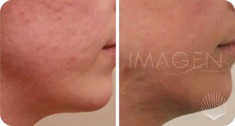 Before and after acne and pore treatment