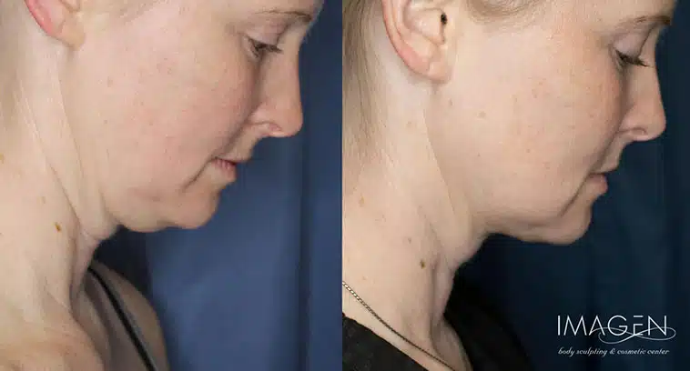 Before and after