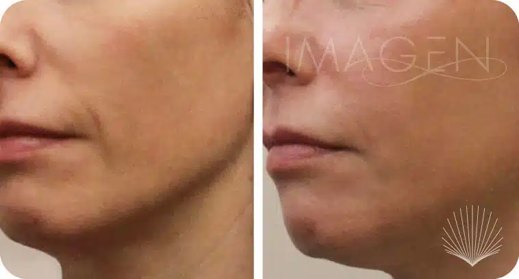 Before and after