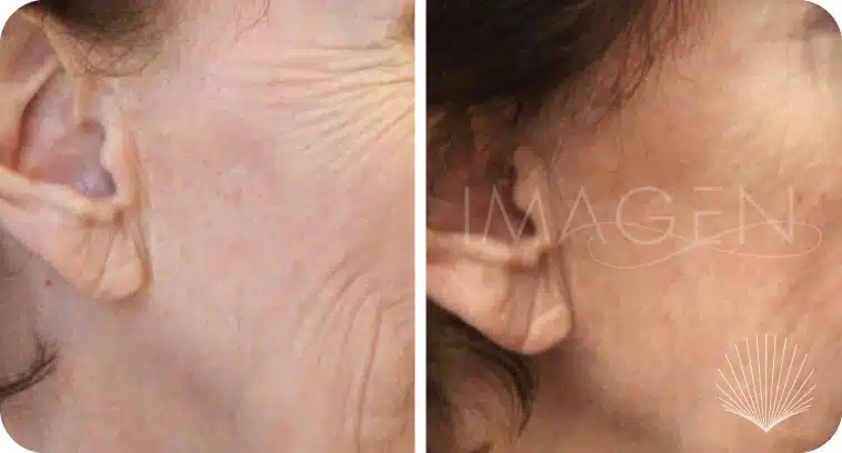 Before and after fractional laser treatment for wrinkles