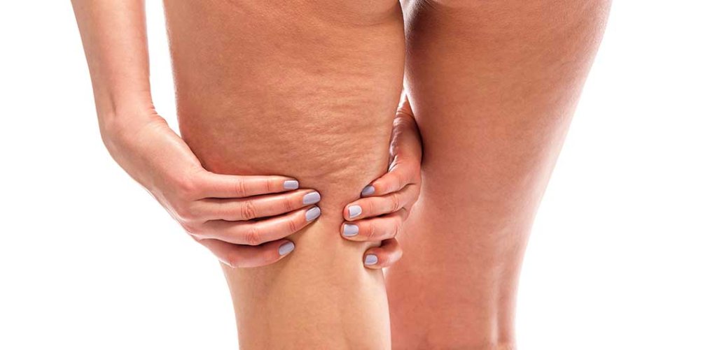 Cellulite treatments