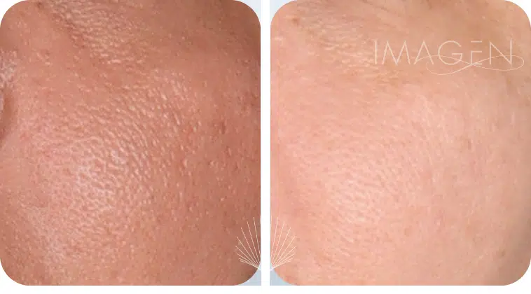 Improved pores after PRP microneedling omaha