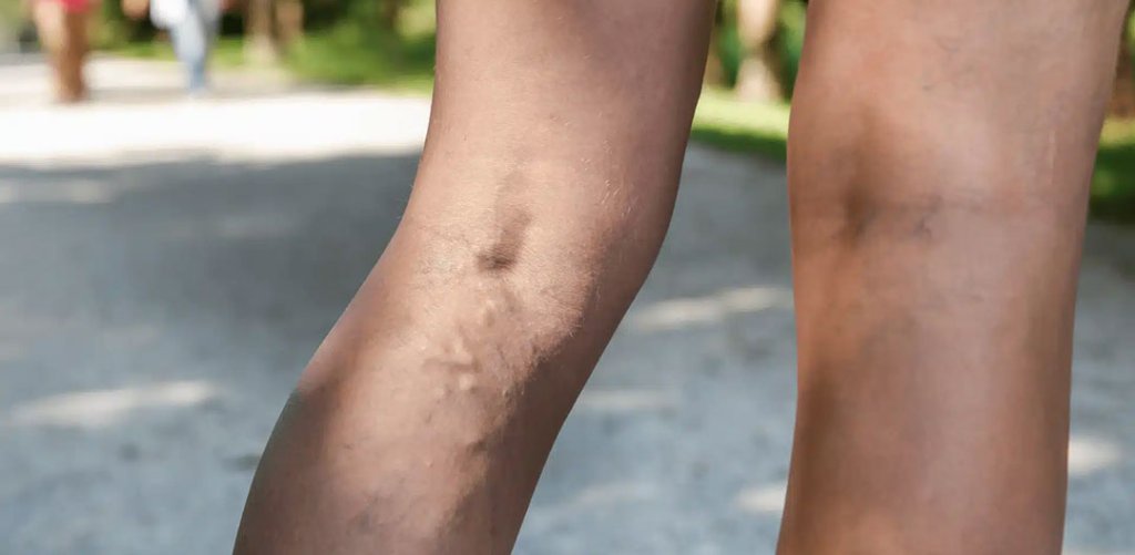Sclerotherapy bruising