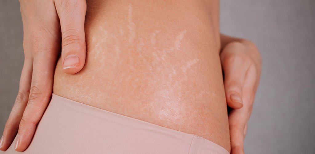 Stretch marks back