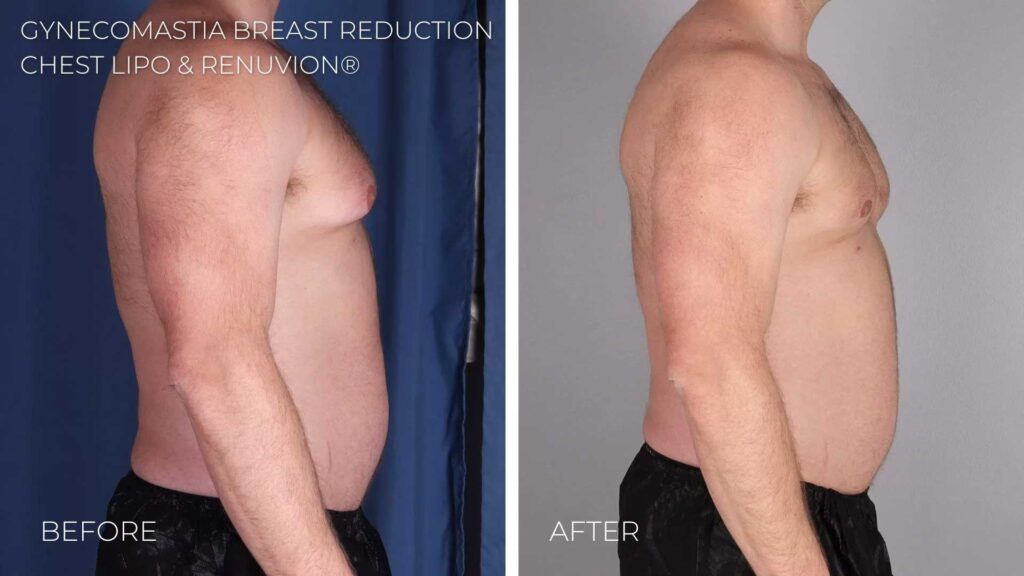 BA-gyncomastia-chest-liposuction7.jpg
