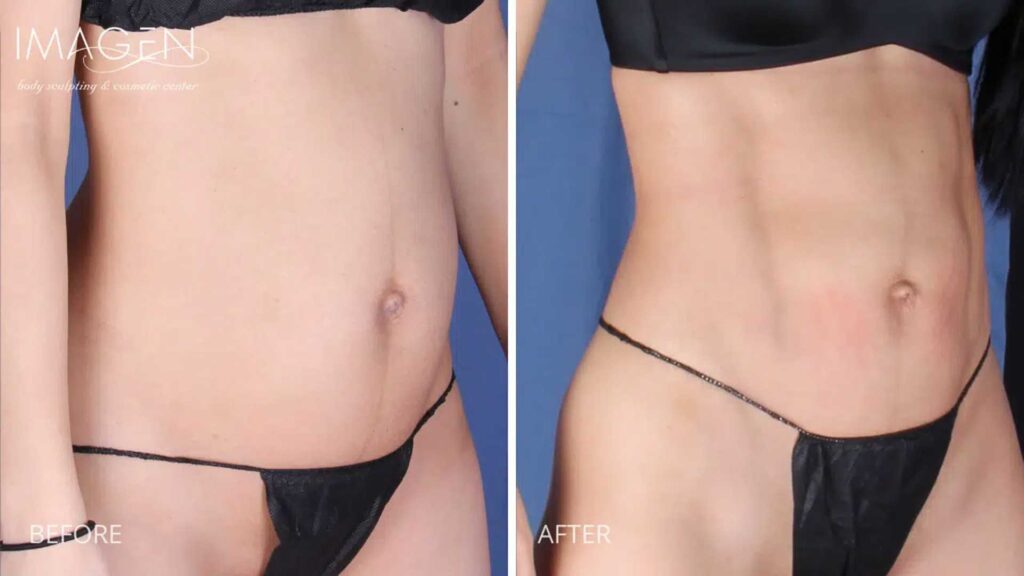 BA-hi-def-lipo360-3-1.jpg