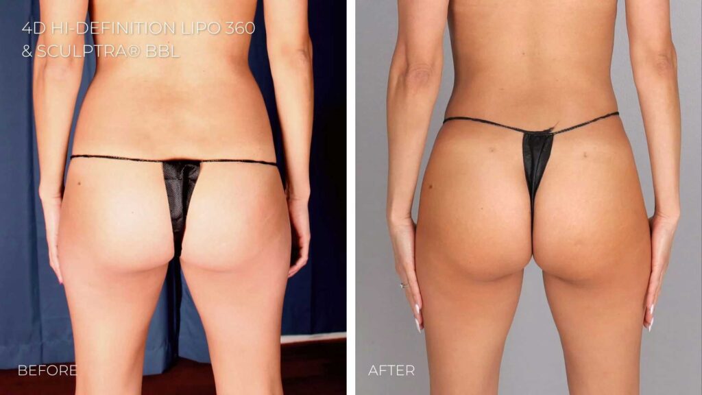 BA-nonsurgical-butt-lift-with-sculptra-1.jpg