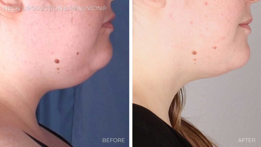 BA-neck-liposuction-renuvion.jpg