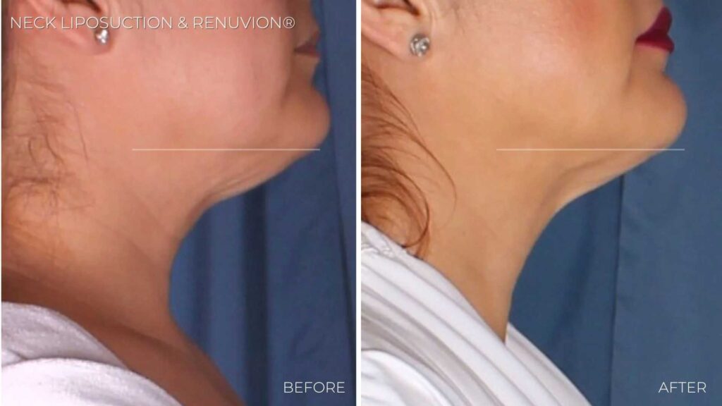 BA-neck-liposuction-renuvion10.jpg