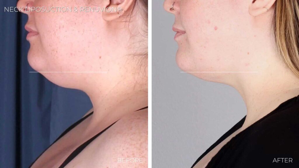 BA-neck-liposuction-renuvion2.jpg