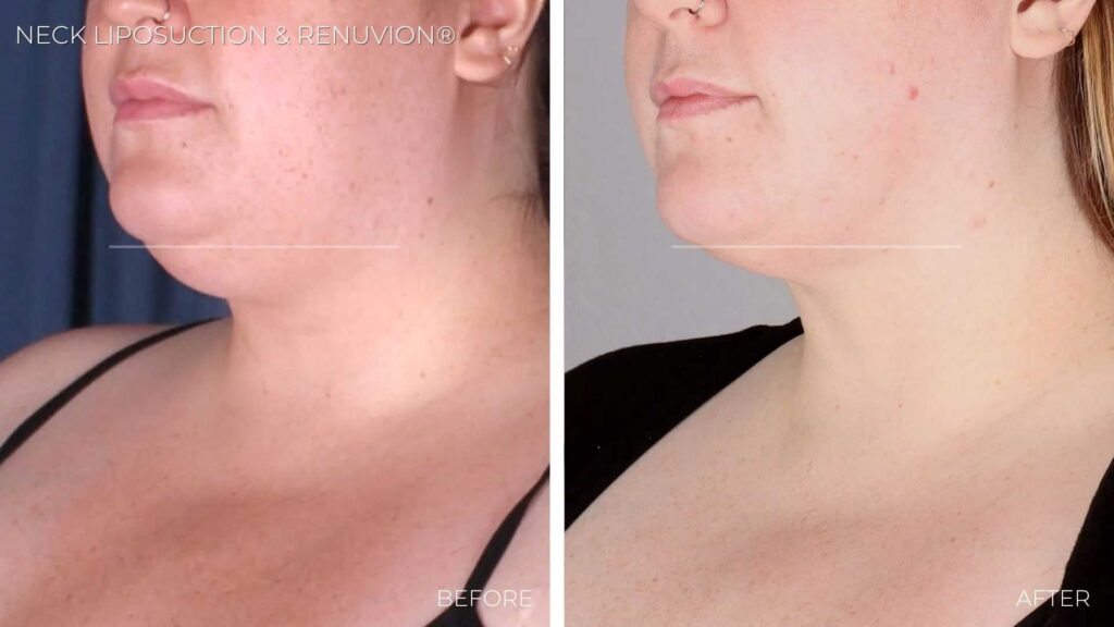 BA-neck-liposuction-renuvion3.jpg