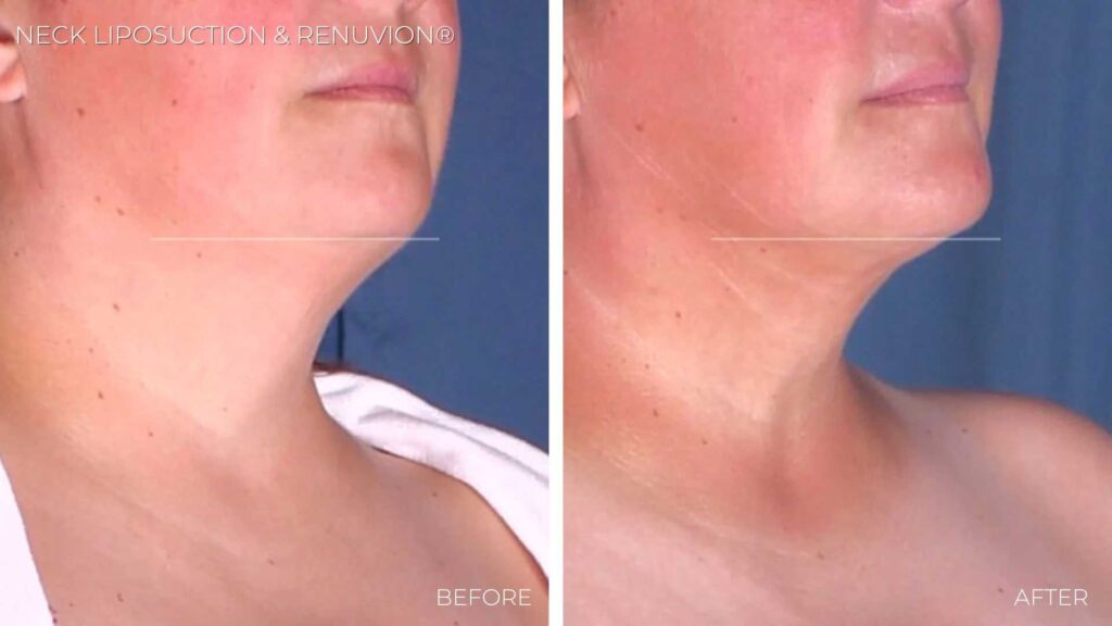 BA-neck-liposuction-renuvion6.jpg