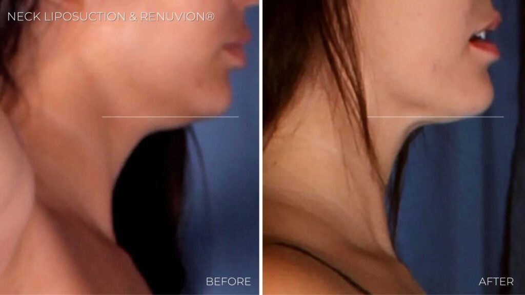 BA-neck-liposuction-renuvion8.jpg