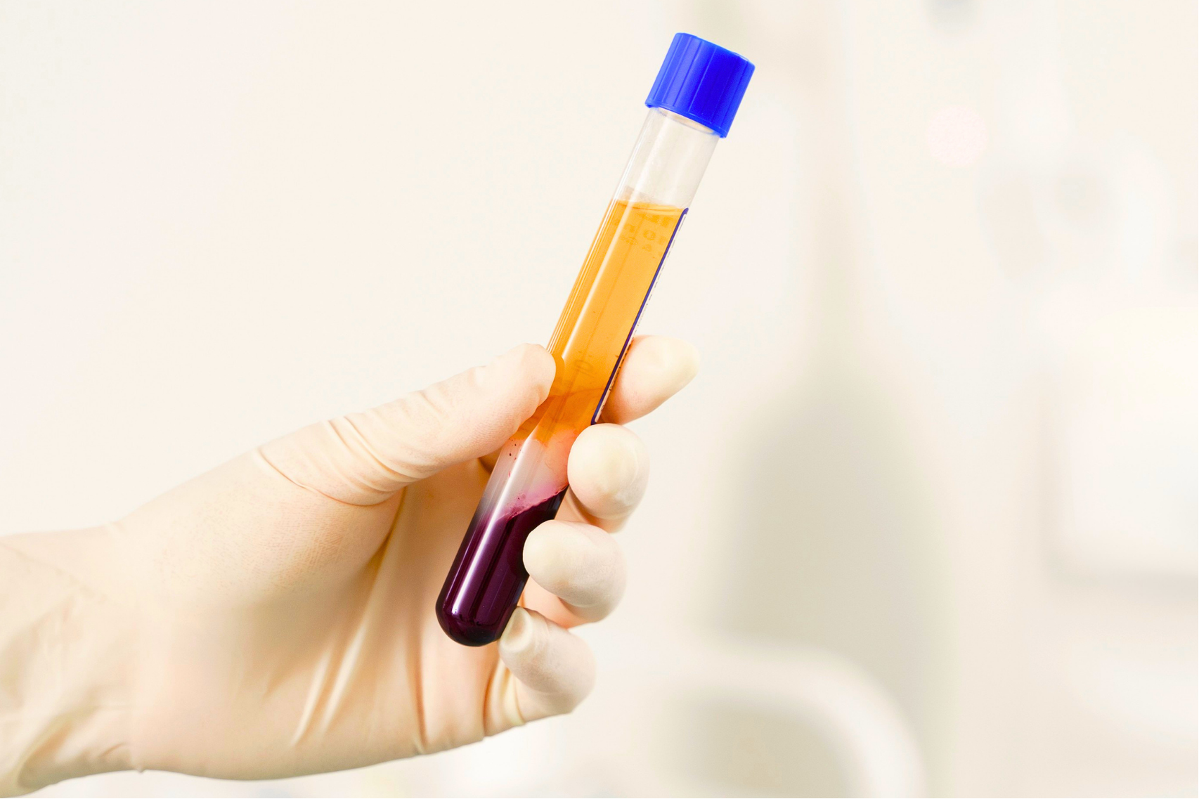 Platelet-rich plasma (PRP) prepared from patient’s blood for natural skin and hair rejuvenation treatment in Omaha