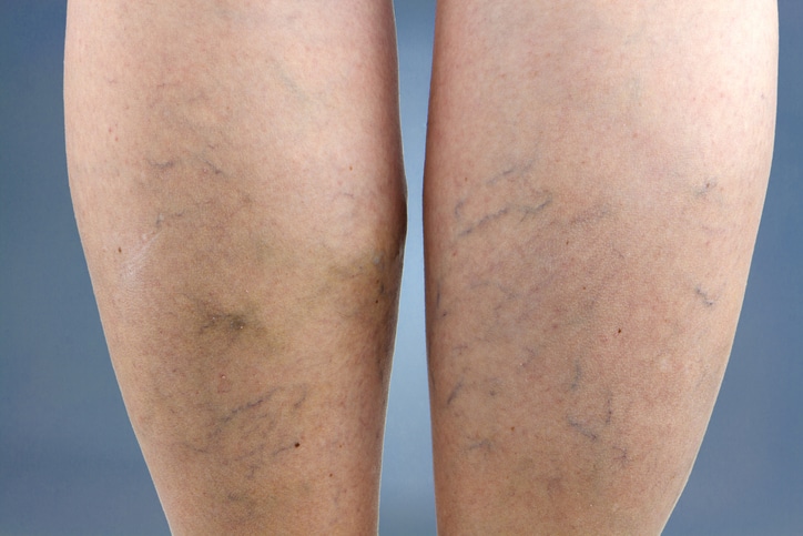 Spider vein treatment