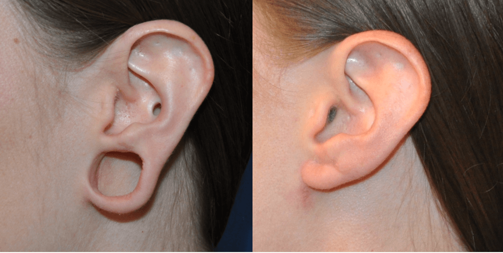 Earlobe repair procedure